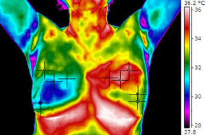 Cancer of the Left Breast